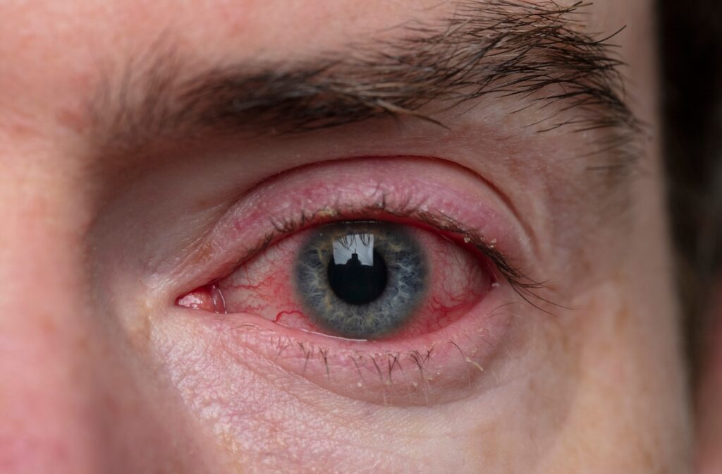 A close up of a man's eye that is severely red with irritated, swollen eyelids