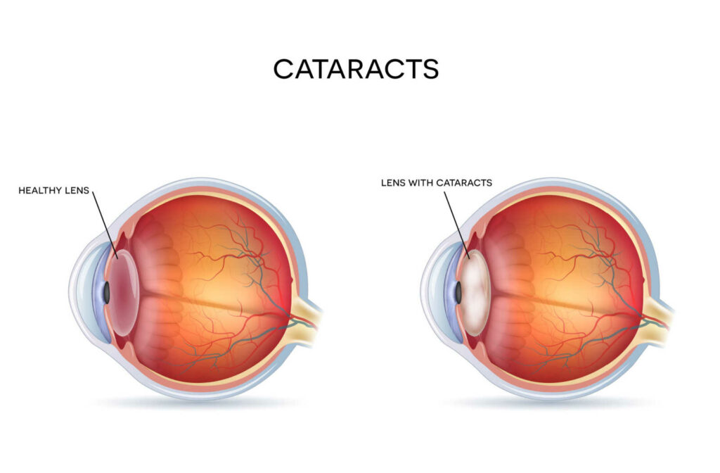 Graphical representation of a cross section of an eye with a healthy lens compared to an eye with a cataract.