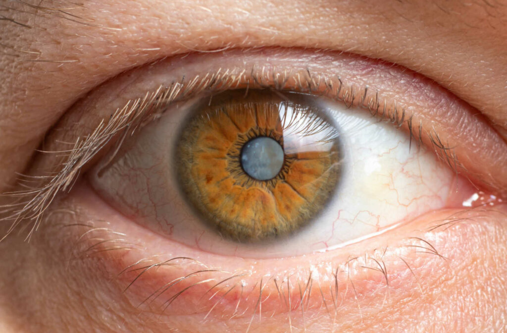 Up close image of an eye with a cataract.