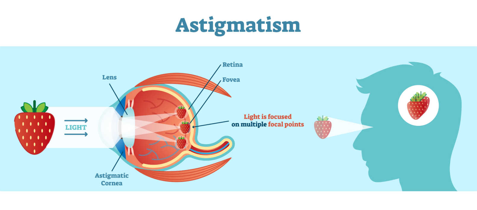 Can I Wear Contacts If I Have Astigmatism? Fort Worth