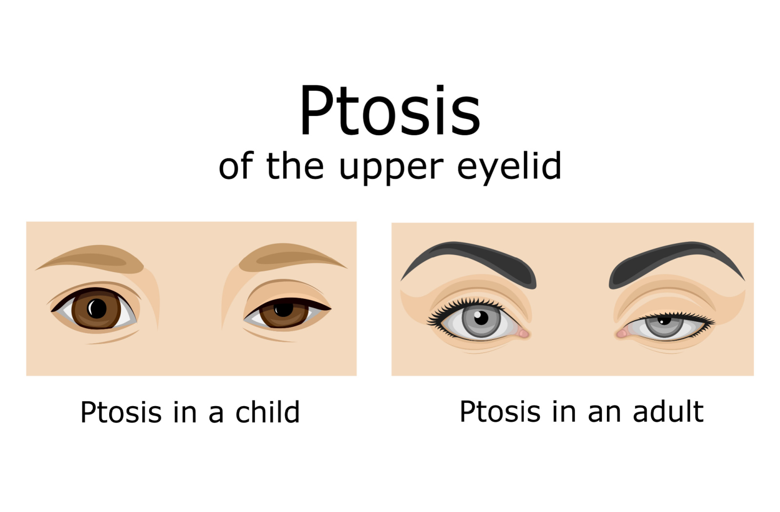 Drawn image showing ptosis of the upper left eyelid in both a child and adult.