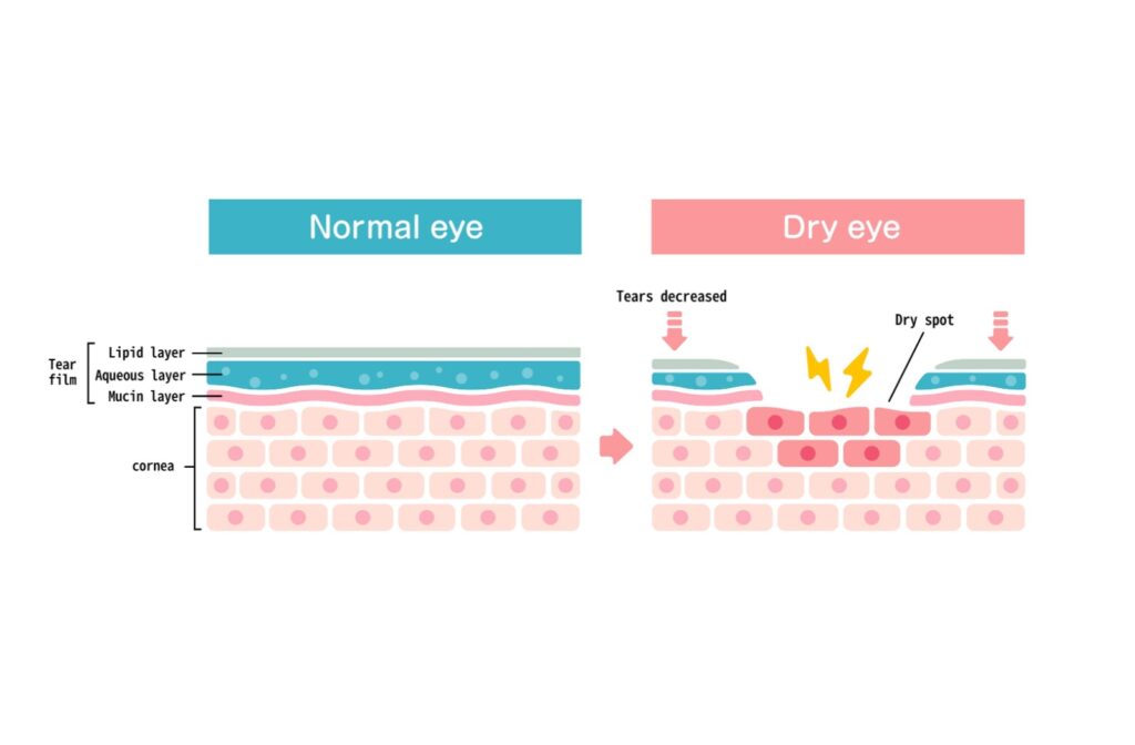 Imaging comparing cell layer of normal eye vs dry eye.